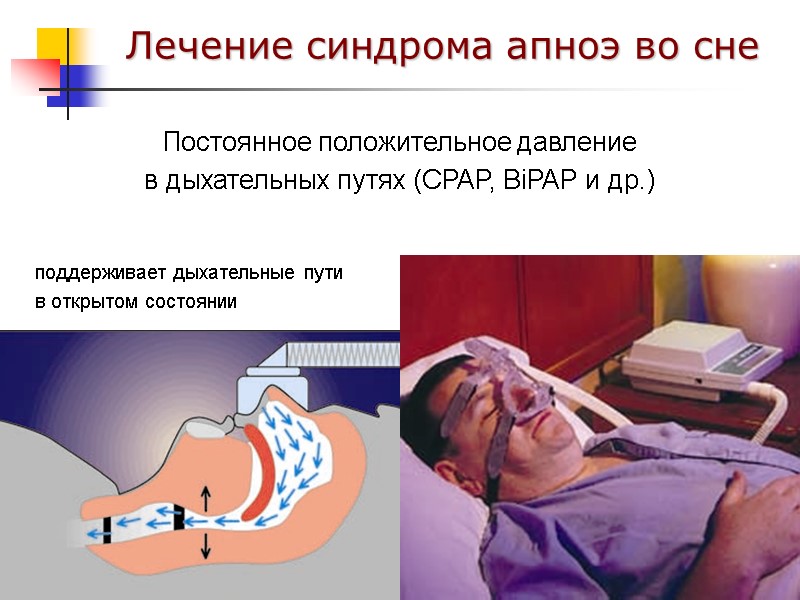 Постоянное положительное давление в дыхательных путях (CPAP, BiPAP и др.) Лечение синдрома апноэ во